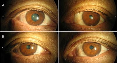 Anti-Hu Antibody-Associated Adie's Pupil and Paraneoplastic Sensorimotor Polyneuropathy Caused by Primary Mediastinal Small Cell Carcinoma